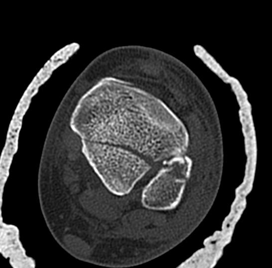 Distal tibial plate 4